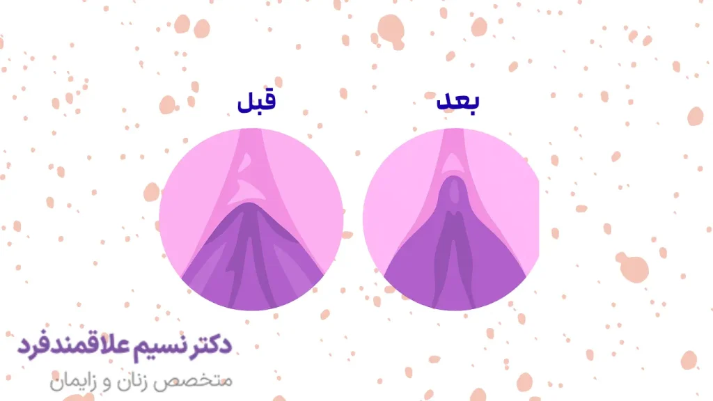 جراحی هودکتومی