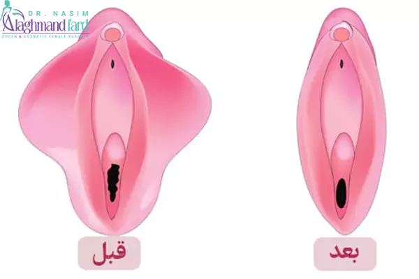 لابیاپلاستی چیست