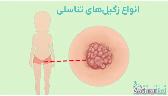 انواع زگیل تناسلی