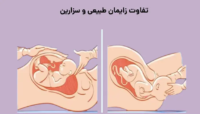 تفاوت زایمان طبیعی و سزارین
