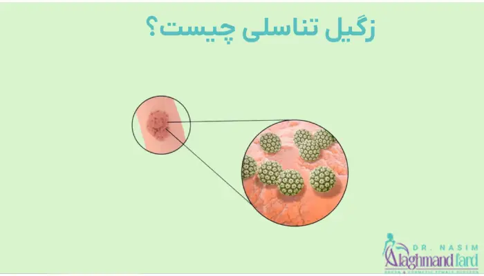 زگیل تناسلی چیست؟