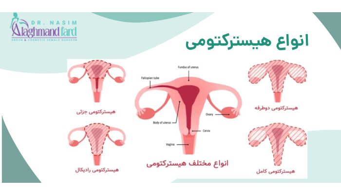 انواع هیسترکتومی