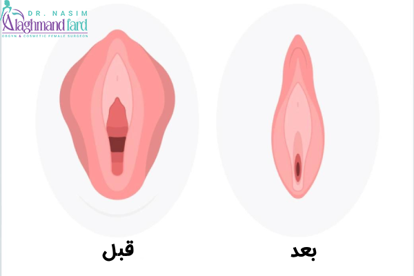 درد بعد از جراحی لابیاپلاستی